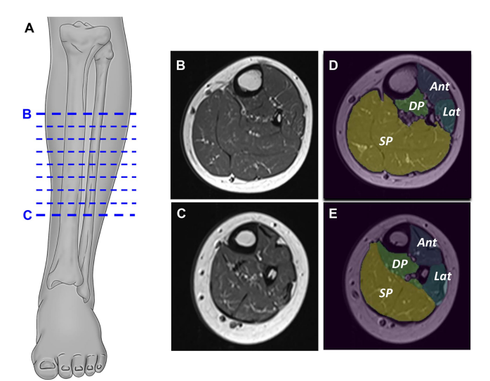 Evaluation of normalized T1 signal intensity obtained using an automated segmentation model in lower leg MRI as a potential imaging biomarker in Charcot&ndash; Marie&ndash;Tooth disease type 1A